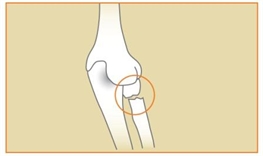 Image related to Elbow Fractures | Houston Fracture Treatment