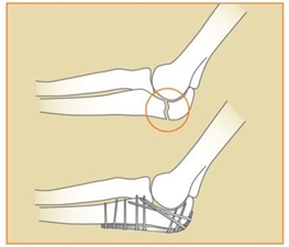 Image related to Elbow Fractures | Houston Fracture Treatment