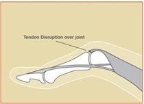 Image related to Extensor Tendon Injuries | Houston Tendon Treatment