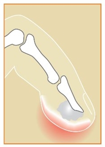 Image related to Hand Infections and Treatment Houston TX