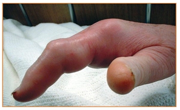 Image related to Hand Infections and Treatment Houston TX