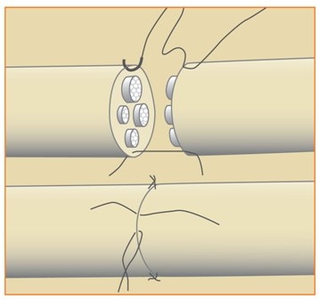 Image related to Nerve Injuries | Dean Smith MD Houston TX