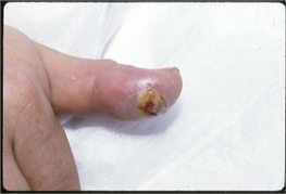 Wound infection of a thumb tip after a human bite