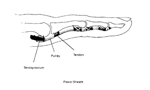 Image related to Trigger Finger or Trigger Thumb | Houston Orthopaedic Surgeon