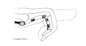 Image related to Trigger Finger or Trigger Thumb | Houston Orthopaedic Surgeon