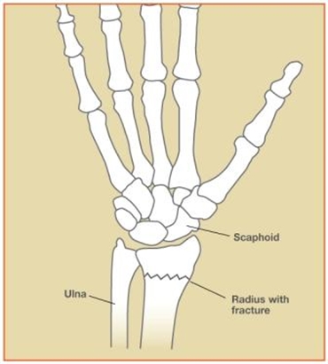 Image related to Wrist Fractures