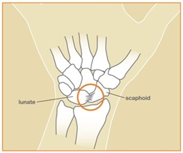 Image related to Wrist Sprains