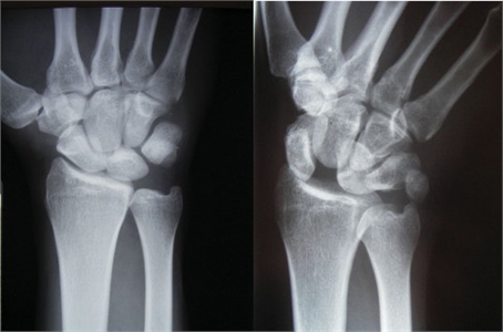 Image related to Wrist Sprains